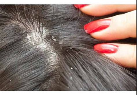dry scalp  symptoms  treatment