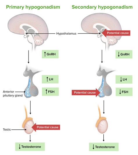 What Is The Difference Between Primary And Secondary Hypogonadism