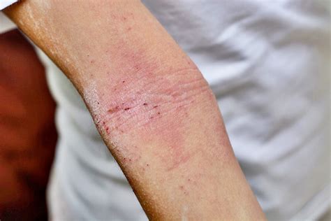 skin rash   treatment