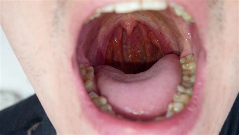 how fast does oral cancer spread