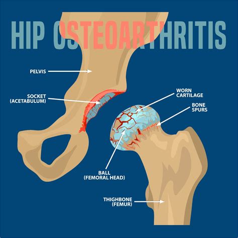 osteoarthritis   hip florida orthopaedic institute