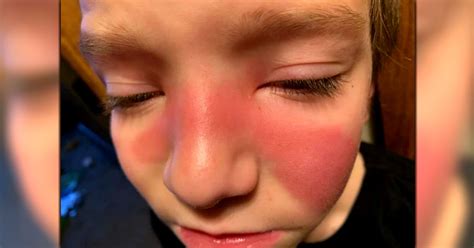 parents issue warning  red marks   sign  strep   sinuses