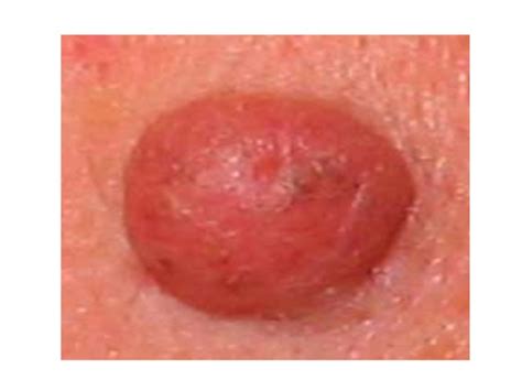 home remedies reviews removing moles skin tag removal and warts trea…