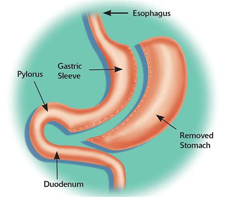 Roux En Y Gastric Bypass Vs Sleeve Gastrectomy Which One