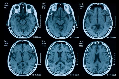 brain mri  eeg clues  covid  related encephalopathy