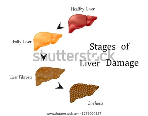 Stages Liver Damage Liver Disease Healthy Stock Vector Royalty Free