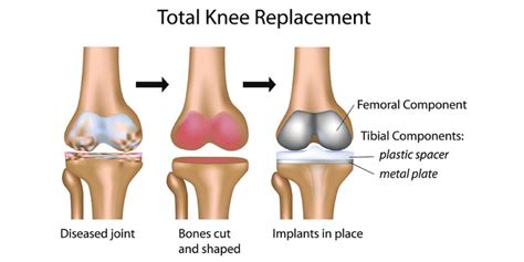 Different Types Knee Replacement Implants And Their Advantages