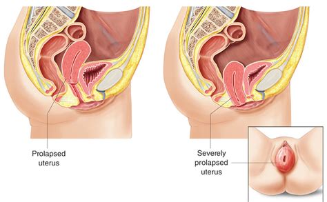 Prolapsed Uterus Causes Signs Symptoms Treatment And