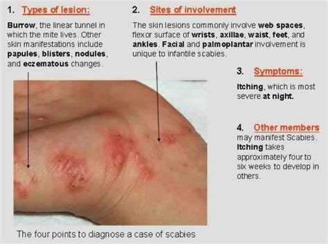 How To Identify Scabies Rash Biayaku