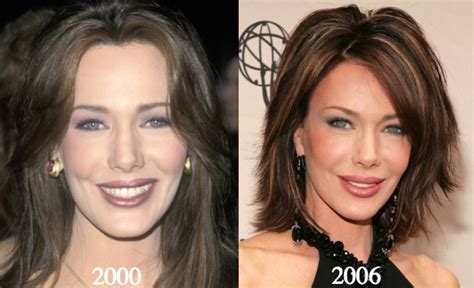 Hunter Tylo Plastic Surgery Before And After Photos
