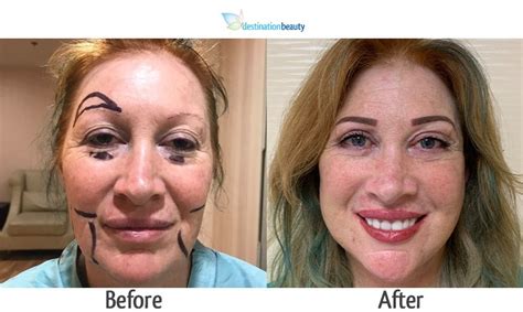 Face Lift Surgery And Eyelid Surgery In Thailand See Ally S Incredible