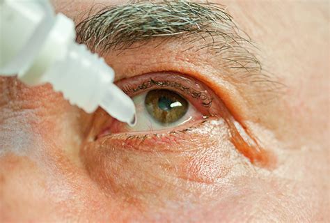 home remedies  soothe itchy eyes emedihealth