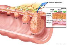 bowel cancer research  pinterest cancer colon cancer  charlotte riley