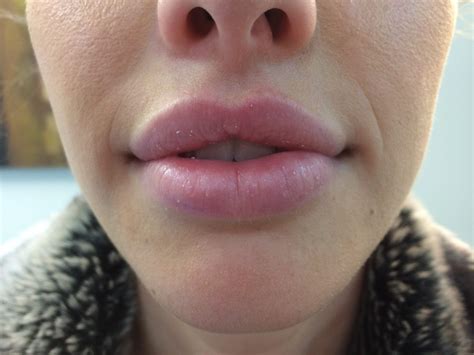 kissable lips    lip fillers creative truckee