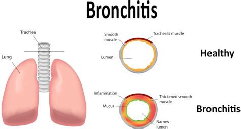 bronchitis symptoms bronchitis treatment and causes bronchitis cure