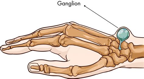 ganglion cysts surgery  treatment  montreal