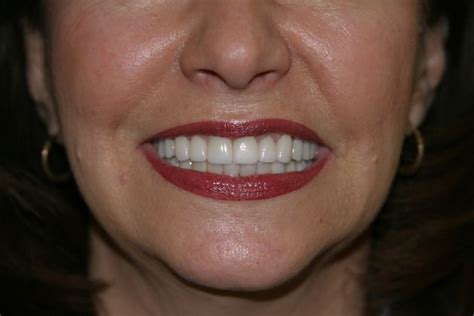 smile makeover cost valdosta ga advanced dental care