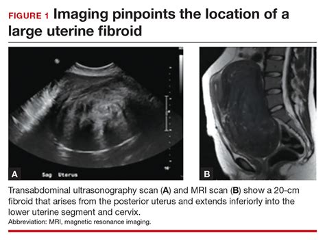 Myomectomy Of A Large Cervical Fibroid In A Patient Desiring Future