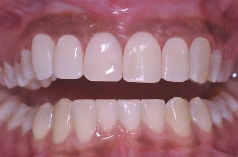 composiet facings hoge kwaliteit  acta tandartsen