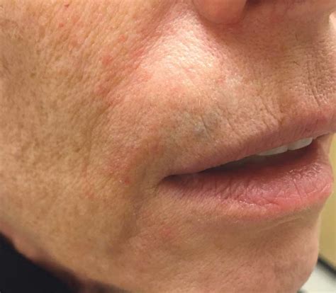 dry scaly rash  upper lip siteliporg