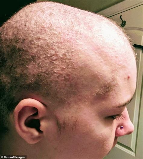 woman with alopecia says her fiance has helped her to love her bald