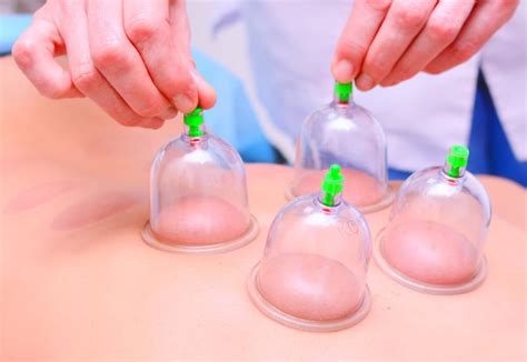 what is myofascial cupping and why we use it at holistic bodyworks