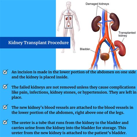 kidney transplant surgeon  india  nephrologist  india  nephrologist consultation