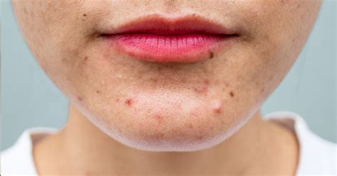 Postpartum Acne Causes And Treatments That Work