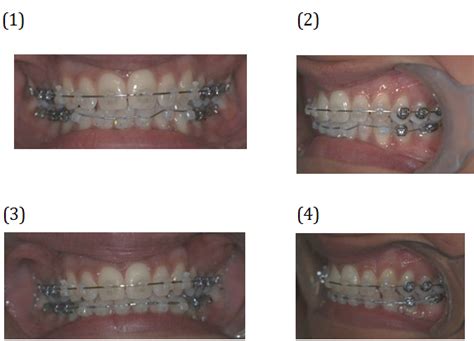 What Happens When You Tighten Braces West London Orthodontist Blog By