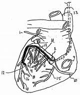Patents Catheter Coronary Sinus sketch template