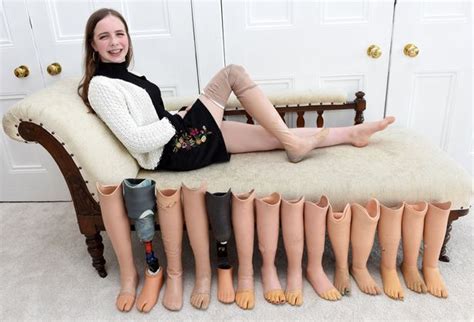 Scottish Teen Who Had Limb Removed When She Was Five Needs New