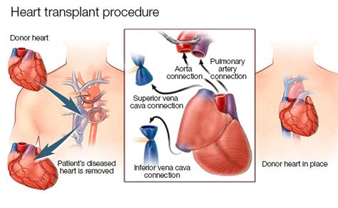 heart transplant contraindications procedure cost