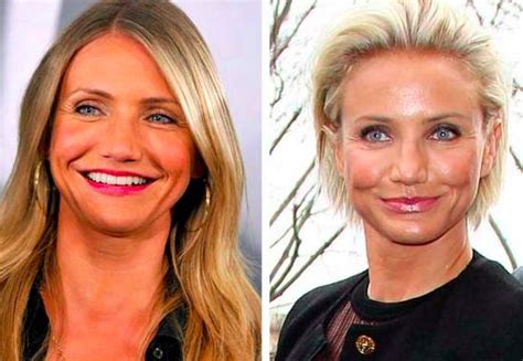 worst cases of celebrity plastic surgery gone wrong