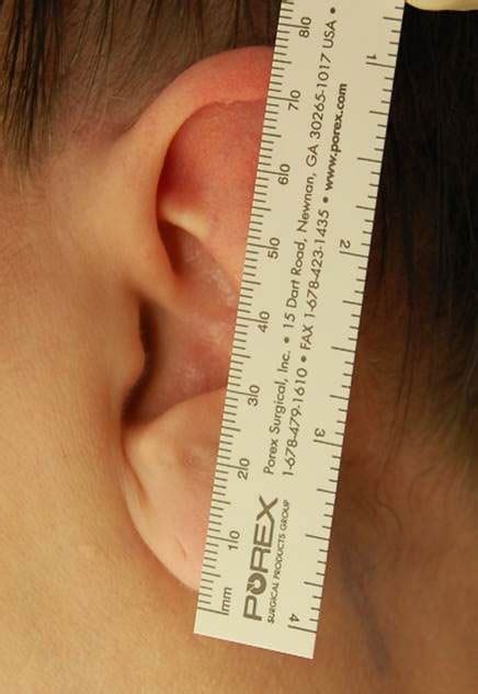 Macrotia Surgery Ear Reduction Ear Reconstruction