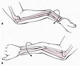 Forearm Volar Apex Angulation Fractures Deformity Mechanism Casting Reduction Closed Supination sketch template