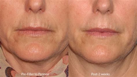 lip lines san diego ca cosmetic laser dermatology