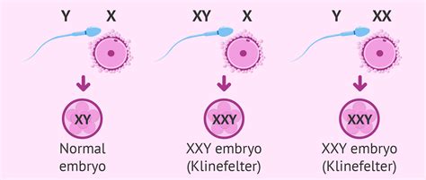 Genetic Causes Of Klinefelter Syndrome