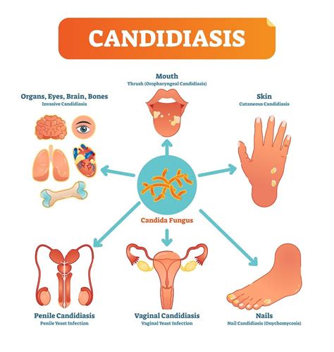 5 Natural Remedies For Candida Yeast Infection Treatment