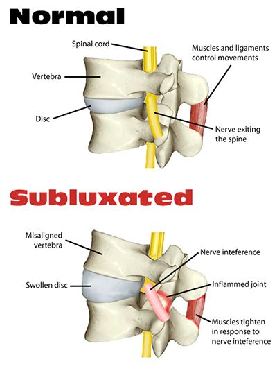 causes of subluxation north shore chiro