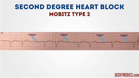 read  ecg ecg interpretation geeky medics