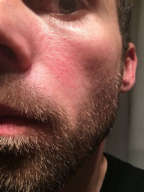 skin concerns red patchy area  cheeks      year rskincareaddiction