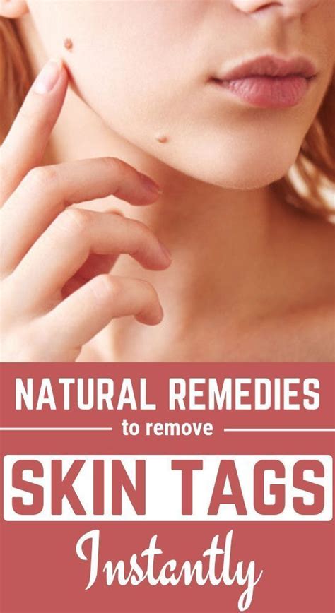 how to get rid of skin tags naturally with images skin tag removal