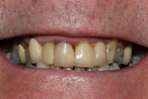 Will’s Crowns And Implants Excel Dental