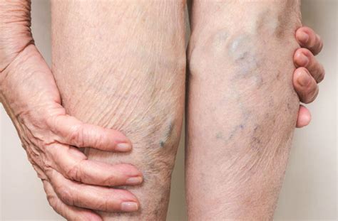 Why Big Blue Varicose Veins Raise A Red Flag Health Essentials From
