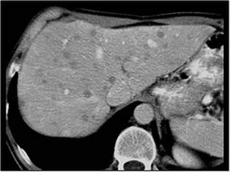 Abdomen And Retroperitoneum 1 1 Liver Case 1 1 8 Malignant Lymphona