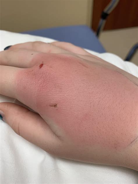 Infected Cat Bite Will Post An Update When Its Ready To Drain And