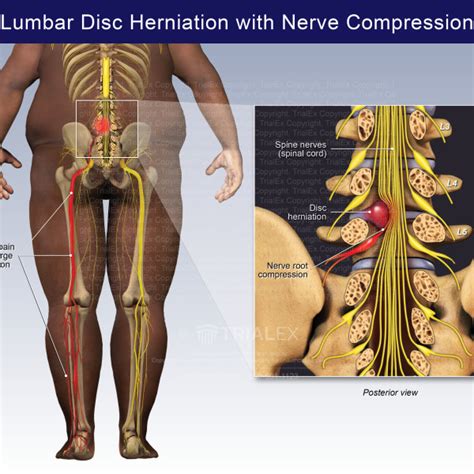 lumbar disc herniation  nerve compression trialexhibits