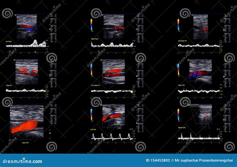 ultrasound doppler  finding deep vein thrombosis stock photo image  diagnosis medicine