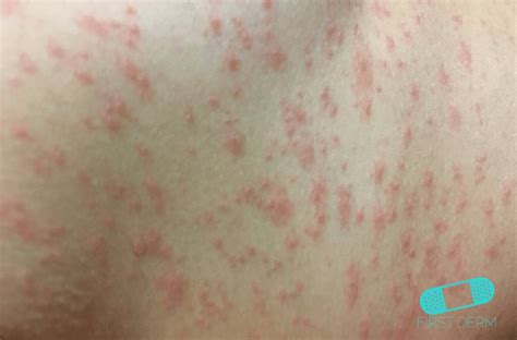 spots and rashes caused by viruses online dermatology