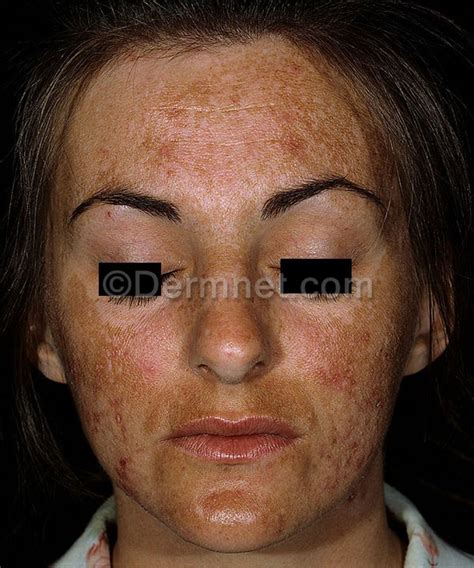 melasma photo skin disease pictures